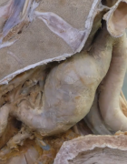 An aorta that has a large aneurysm