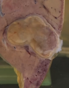 A human liver with a large cyst