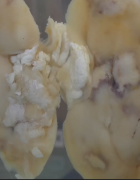 A kidney with an area of infarcted tissue